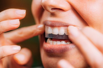 Closeup of patient putting on whitening strip