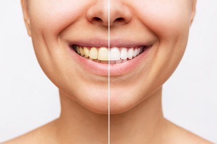Closeup of patient's smile before and after teeth whitening