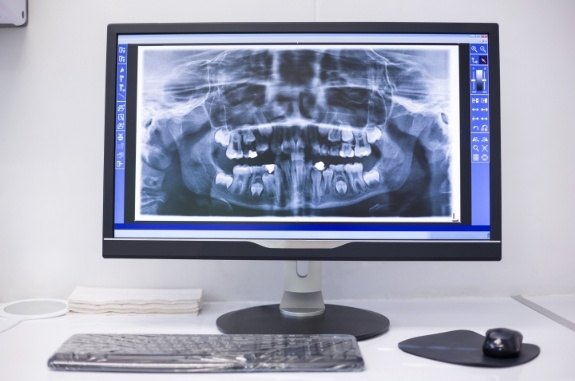 Computer screen showing digital dental x rays