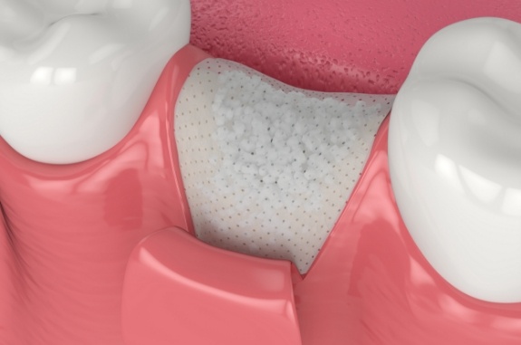 Animated dental bone grafting material in gums where a tooth used to be