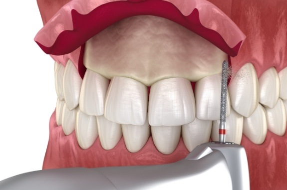 Animated dental gum grafting procedure