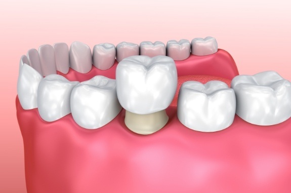 Animated dental crown in Clute being placed over a tooth