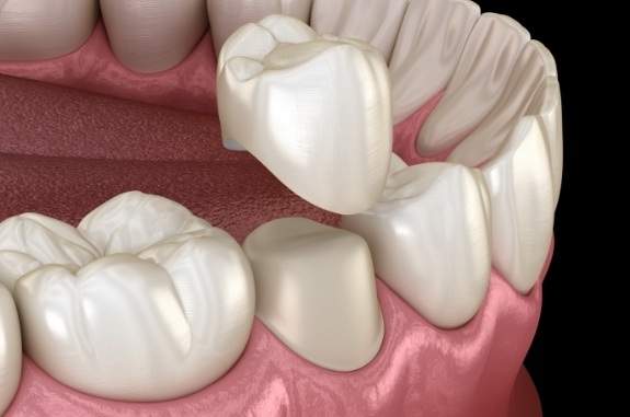 Animated dental crown being fitted over a tooth