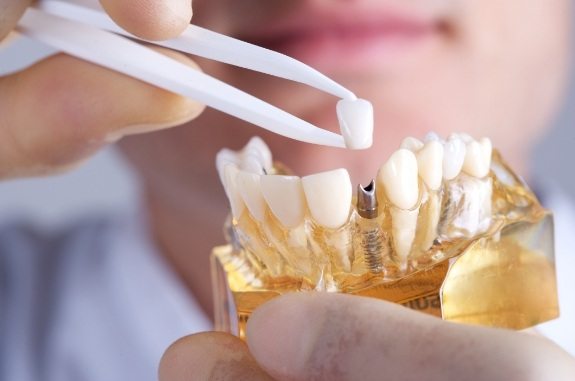 Dentist placing dental crown on model of dental implant in Clute