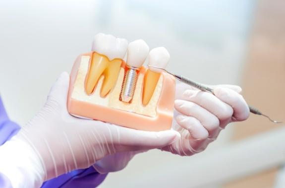 Dentist pointing to a model of a dental implant in the jaw