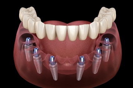 Six animated dental implants with full implant denture