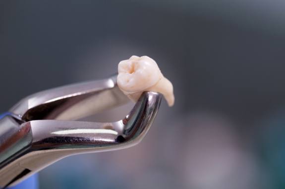 Extracted tooth being held in pair of dental forceps