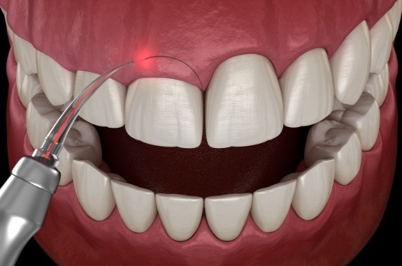 Animated laser treating gum disease