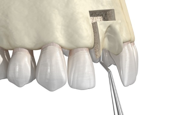 Animated dental bone grafting procedure in upper jaw