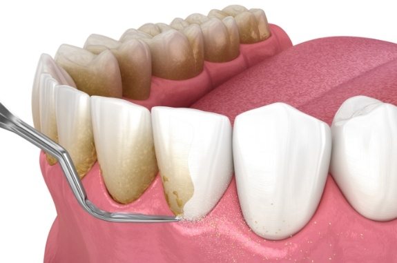 Animated dental tools removing plaque from teeth during gum disease treatment in Clute