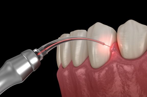 Animated soft tissue laser treating gum disease