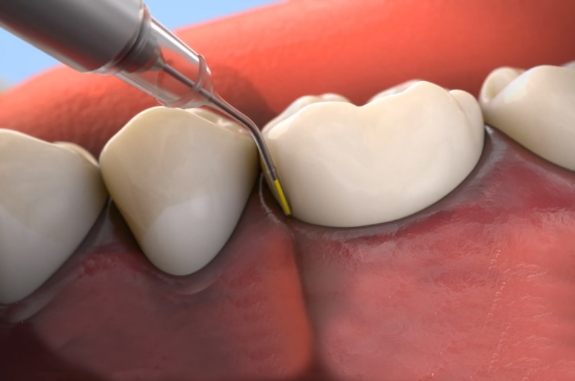 Animated topical antibiotic being applied to the gums