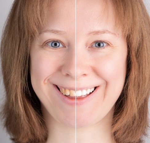 Colored image of woman's face showing imperfect teeth on one side and flawless teeth on other