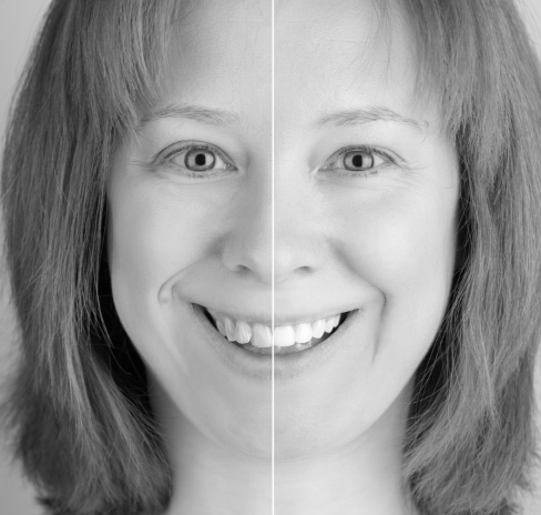 Black and white image of woman's face showing imperfect teeth on one side and flawless teeth on other