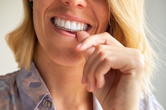 Woman putting clear aligner on top teeth