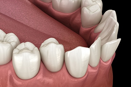 Illustration of crowded teeth