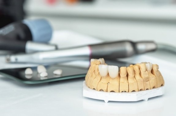 Three dental Lumineers in Clute on model of row of teeth