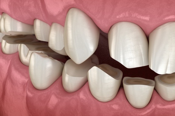 Animated misaligned teeth that need occlusal adjustment in Clute