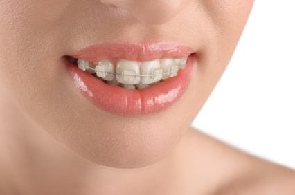 Close up of a person with ceramic braces