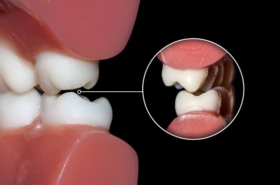 Animated close up of upper and lower teeth not coming together properly