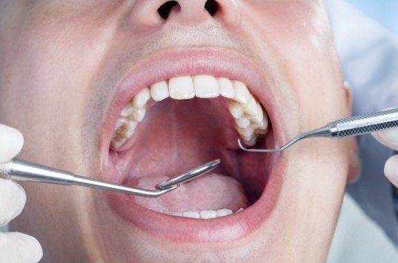 Close up of mouth with dental exam tools inside of it