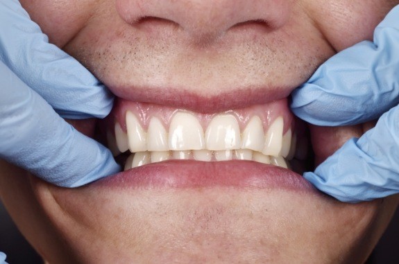 Gloved hands pulling back a person's lips to examine their teeth