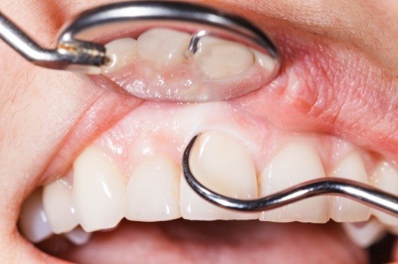 Close up of dental instruments examining a person's teeth and gums