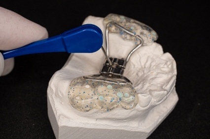 Dentist with a palatal expander on a model of the upper jaw