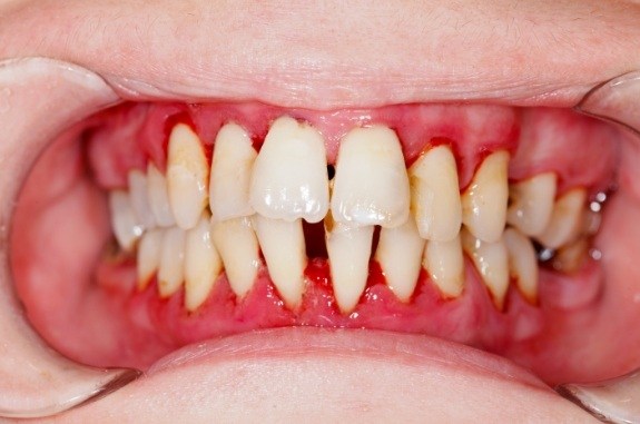 Close up of mouth with red gums and long teeth needing osseous surgery in Clute