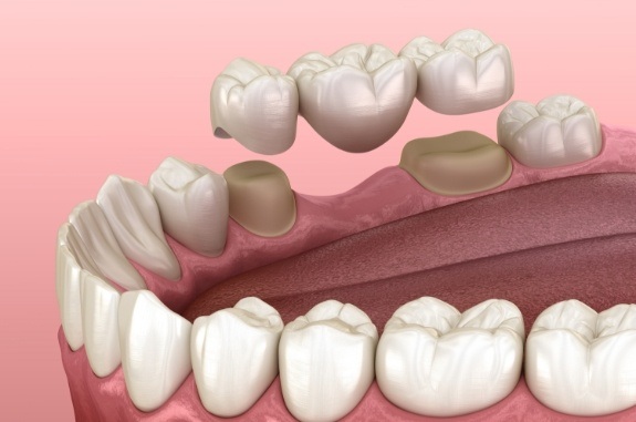 Animated dental bridge replacing a missing tooth in Clute