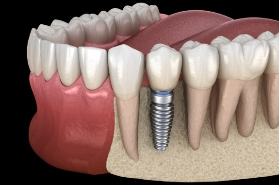 Animated dental implant with crown replacing a missing lower tooth