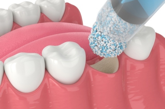 Animated bone grafting material being placed in socket after tooth extraction