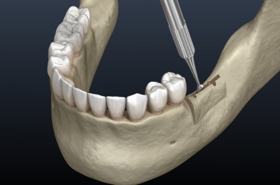 Animated jawbone ridge being widened by dental tools