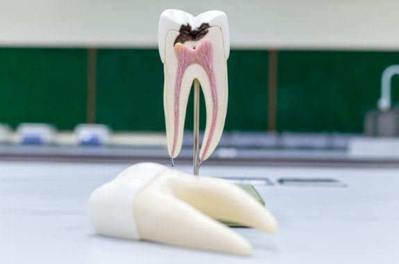 Model of damaged tooth that needs root canal treatment in Clute