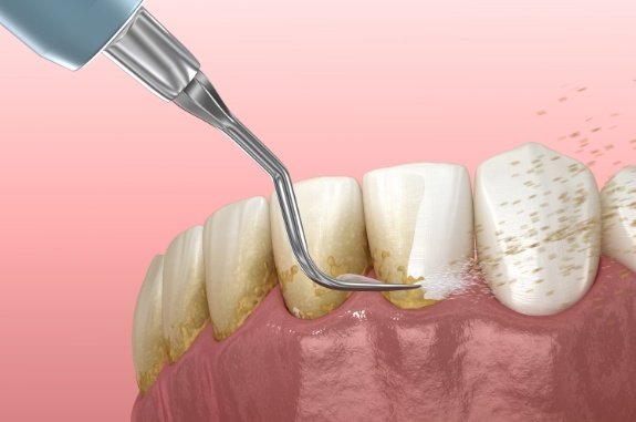 Animated dental tools removing plaque from teeth during dental scaling and root planing in Clute