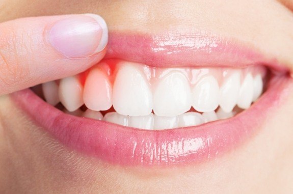 Close up of person pointing to red area of their gums