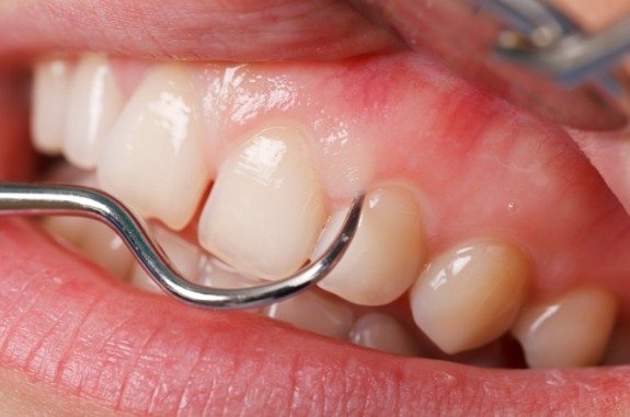 Close up of dental instrument in mouth