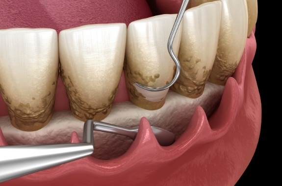 Animated dental tool smoothing the roots of teeth