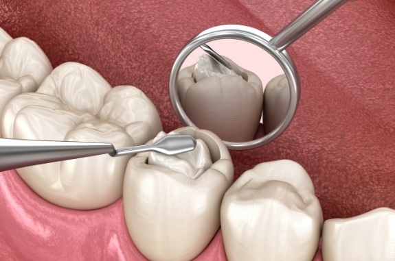 Animated tooth receiving a tooth colored filling in Clute