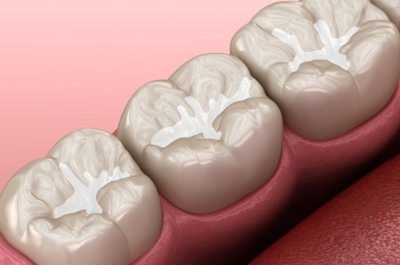 Row of animated teeth with tooth colored fillings