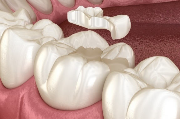 Animated tooth colored filling being placed on a tooth