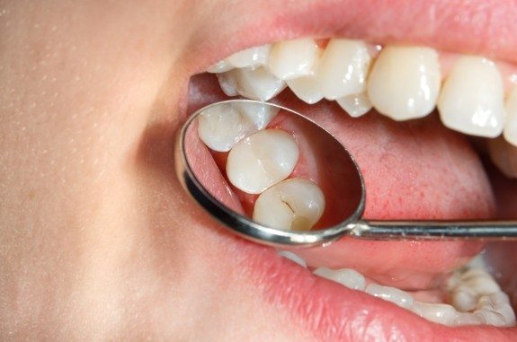 Close up of dental mirror inside of a mouth