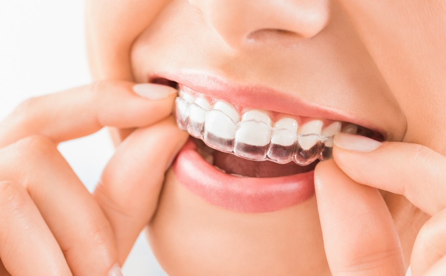 Woman putting on Invisalign